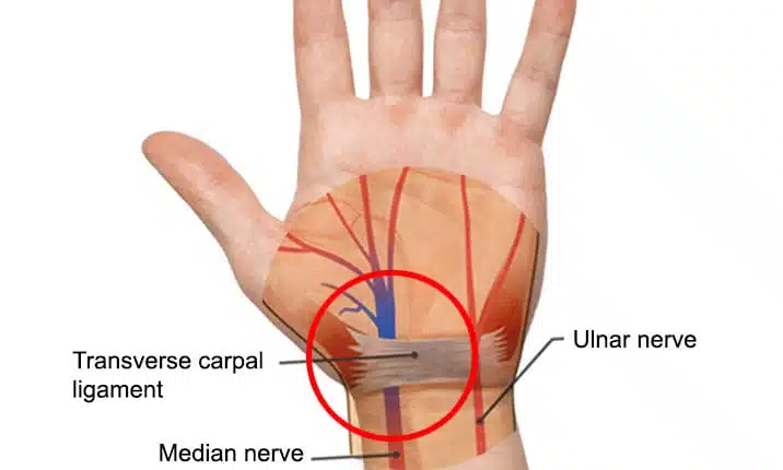 Carpal Tunnel Syndrome: Jangan Anggap Sepele Tangan yang Sering Kesemutan